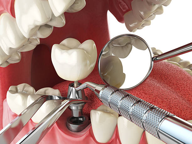Best Urgent Tooth Repair  in Richmond, UT